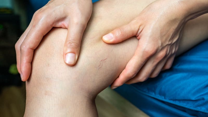 Kosmetický problém? Žilní onemocnění zatěžují i psychiku, pacienti mohou trpět depresí